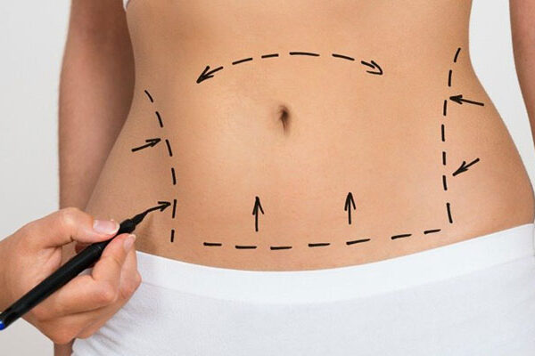 ابدومینوپلاستی یا جراحی زیبایی شکم در اهواز ابدومینوپلاستی یا جراحی زیبایی شکم در اهواز