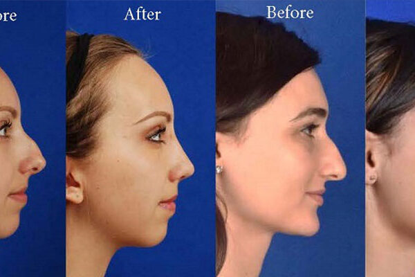 جراحی بینی در اهواز | جراح پلاستیک بینی در اهواز جراحی بینی در اهواز | جراح پلاستیک بینی در اهواز