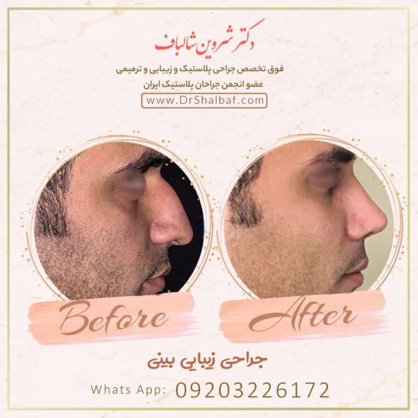 جراحی بینی در اهواز جراحی بینی در اهواز