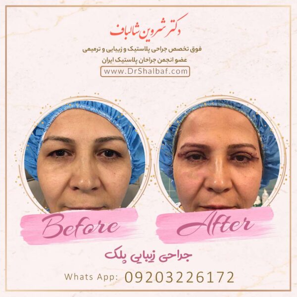 جراحی بینی در اهواز جراحی بینی در اهواز